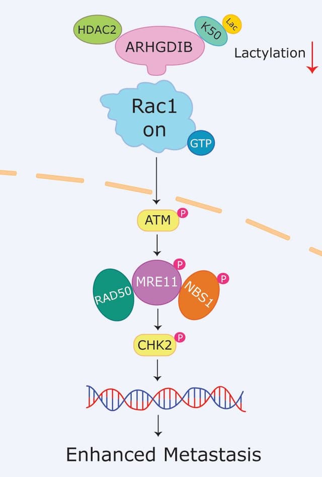 Delactylation of the tumor suppressor ARHGDIB drives metastasis and chemoresistance in bladder cancer